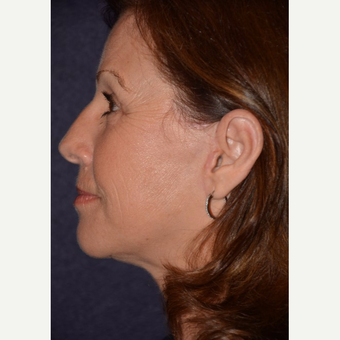 55-64 year old woman treated with Eye Bags Treatment after 3466680