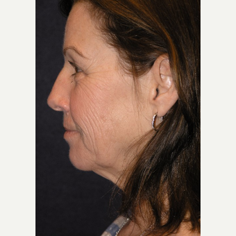 55-64 year old woman treated with Eye Bags Treatment before 3466680