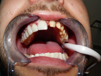 Porcelain Veneers before 1019814