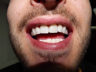 Porcelain Veneers after 1019814