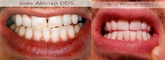 Porcelain Veneers 1019814