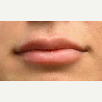 18-24 year old woman treated with Lip Augmentation before 3749617
