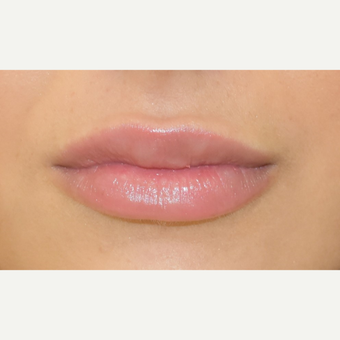 18-24 year old woman treated with Lip Augmentation after 3749617