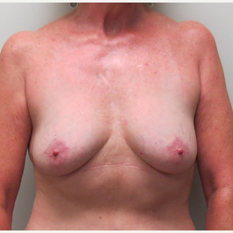 Breast Fat Transfer or Natural Breast Augmentation for this 54 Year Old Woman after 2997995