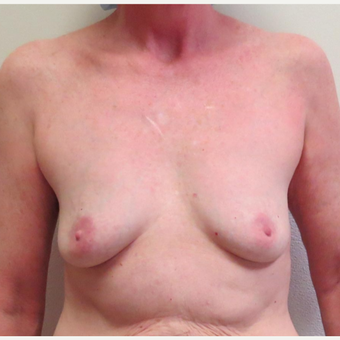 Breast Fat Transfer or Natural Breast Augmentation for this 54 Year Old Woman before 2997995