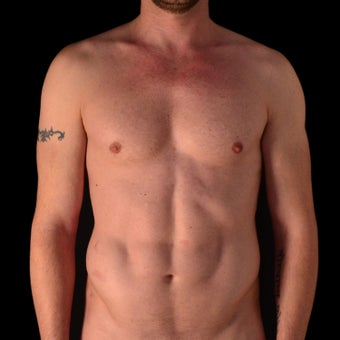 Liposculpture after 1246814