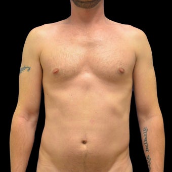 Liposculpture before 1246814