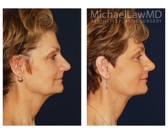 Cheek Augmentation before 1324868