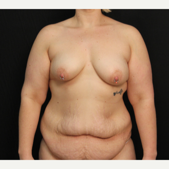 33 year old female with bilateral submuscular silicone implants placed through the underarm before 3576141