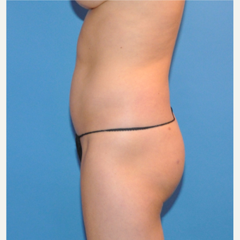 Liposuction of the abdomen and waist before 3530713