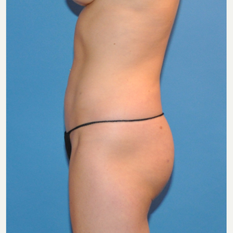 Liposuction of the abdomen and waist after 3530713