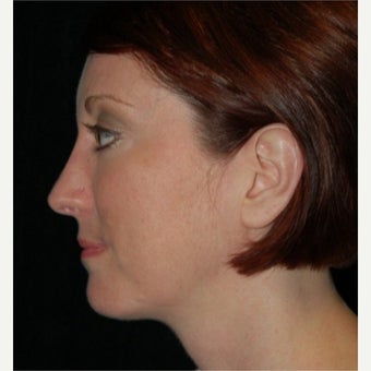 Rhinoplasty 1772946