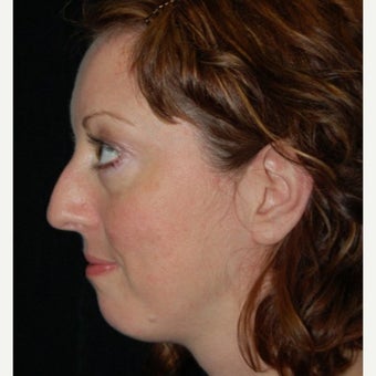 Rhinoplasty 1772946