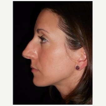 25-34 year old woman treated with Rhinoplasty before 3047048