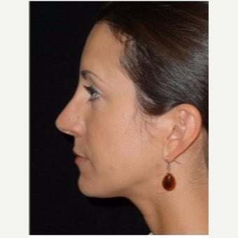 25-34 year old woman treated with Rhinoplasty after 3047048
