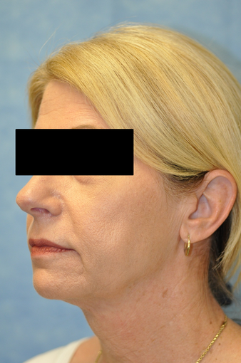 57 Year Old Female Treated for Skin Laxity of the Neck after 1017387