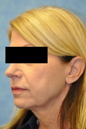 57 Year Old Female Treated for Skin Laxity of the Neck before 1017387