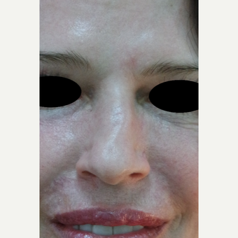 35-44 year old woman treated with Rhinoplasty before 3637821
