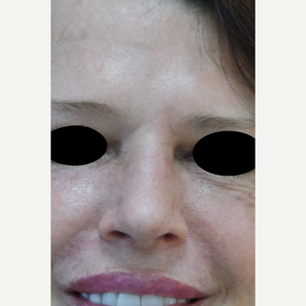 35-44 year old woman treated with Rhinoplasty after 3637821