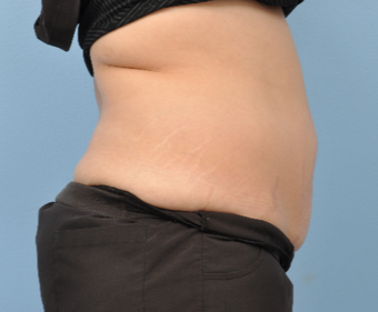 35-44 year old woman treated with CoolSculpting after 3802068