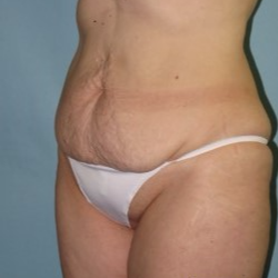 35-44 year old woman treated with Tummy Tuck before 3722156