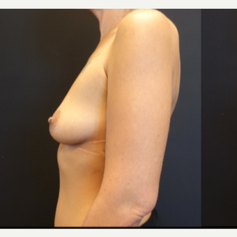 25-34 year old woman treated with Breast Augmentation before 3787616