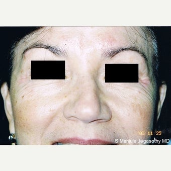 Botox Cosmetic® Used to Treat Eye Wrinkles after 2148391