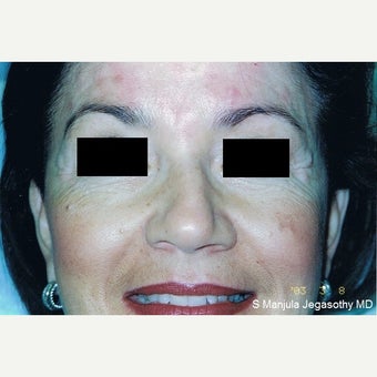 Botox Cosmetic® Used to Treat Eye Wrinkles before 2148391