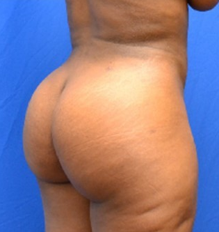 34 Year Old Female, Brazilian Butt Lift after 1498134