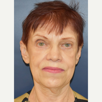65-74 year old woman treated with MACS Facelift before 3449089