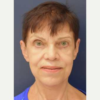65-74 year old woman treated with MACS Facelift after 3449089