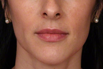 35-44 year old woman treated with Botox for masseter reduction after 3181469