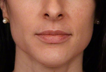35-44 year old woman treated with Botox for masseter reduction before 3181469