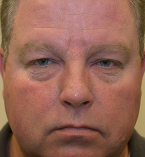 Upper and Lower Blepharoplasty and Lower Lid Fillers before 1722930
