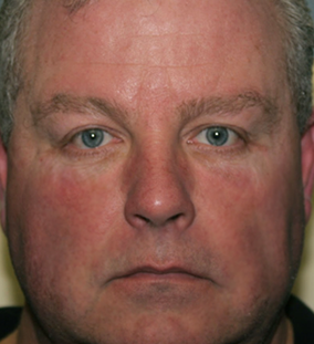 Upper and Lower Blepharoplasty and Lower Lid Fillers after 1722930