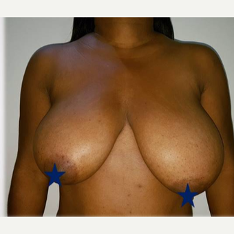 35-44 year old woman treated with Breast Reduction before 3300354