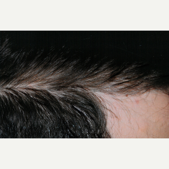 25-34 year old man treated with PRP for Hair Loss after 3803928