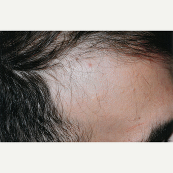 25-34 year old man treated with PRP for Hair Loss before 3803928