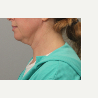 35-44 year old woman treated with Skin Rejuvenation before 3495222