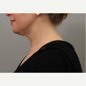 35-44 year old woman treated with Skin Rejuvenation after 3495222