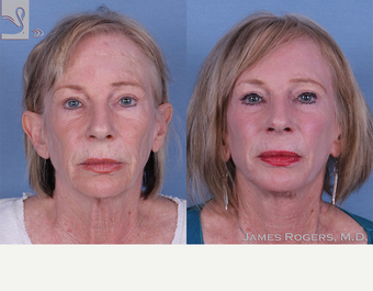 55-64 year old woman treated with Facelift before 3844167