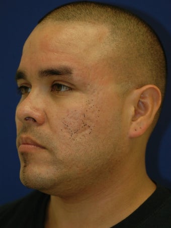 Subcision on a 37 Year Old Hispanic Male for Rolling Acne Scars before 902368