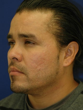 Subcision on a 37 Year Old Hispanic Male for Rolling Acne Scars after 902368