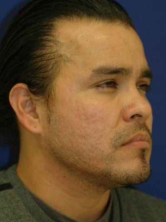 Subcision on a 37 Year Old Hispanic Male for Rolling Acne Scars 902368