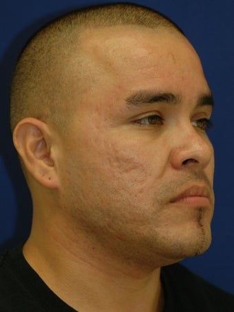 Subcision on a 37 Year Old Hispanic Male for Rolling Acne Scars 902368