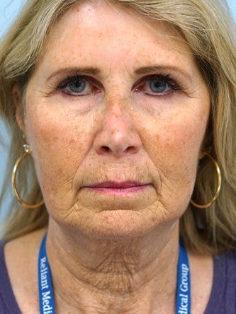 55-64 year old woman treated with Fractional Laser before 2558350