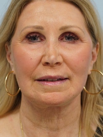 55-64 year old woman treated with Fractional Laser after 2558350