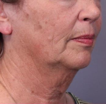 55-64 year old woman treated with Facelift before 3782457