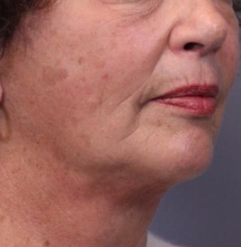 55-64 year old woman treated with Facelift after 3782457