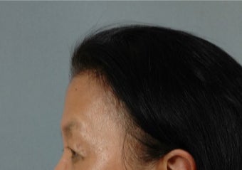 45-54 year old woman treated with Asian Eyelid Surgery before 3615939